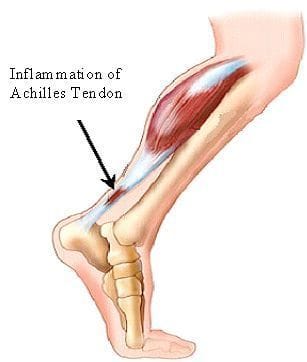 Achilles Tendonitis